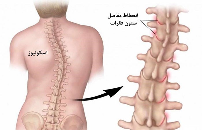 درمان انحراف ستون فقرات